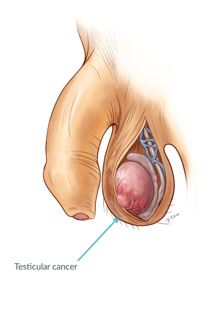 Self testicular exam cancer Testicular Cancer