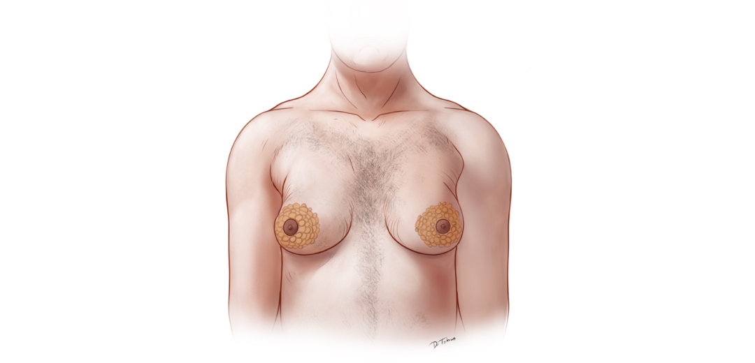 Gynecomastia