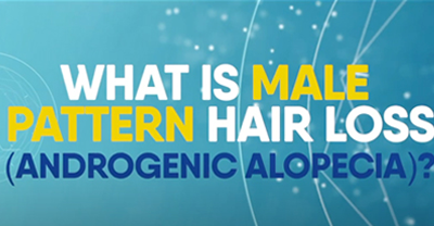 Alopecia – Male pattern hair loss