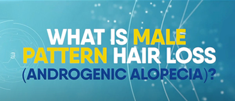 Alopecia – Male pattern hair loss