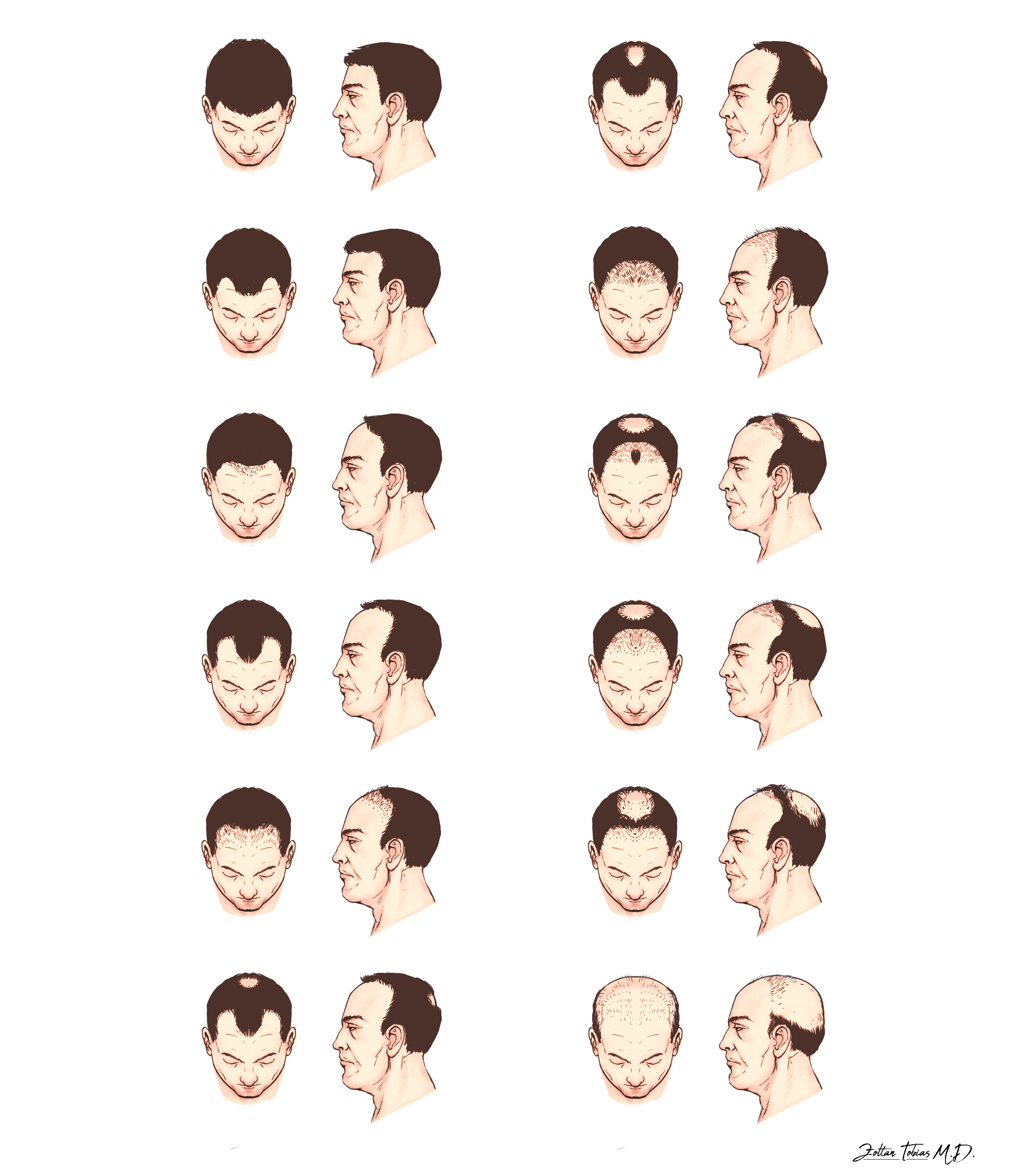 alopecia_f